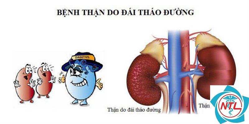 bệnh thận mạn do đái tháo đường - Image 3