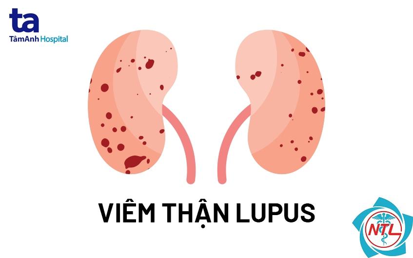 bệnh thận mạn do lupus - Image 4