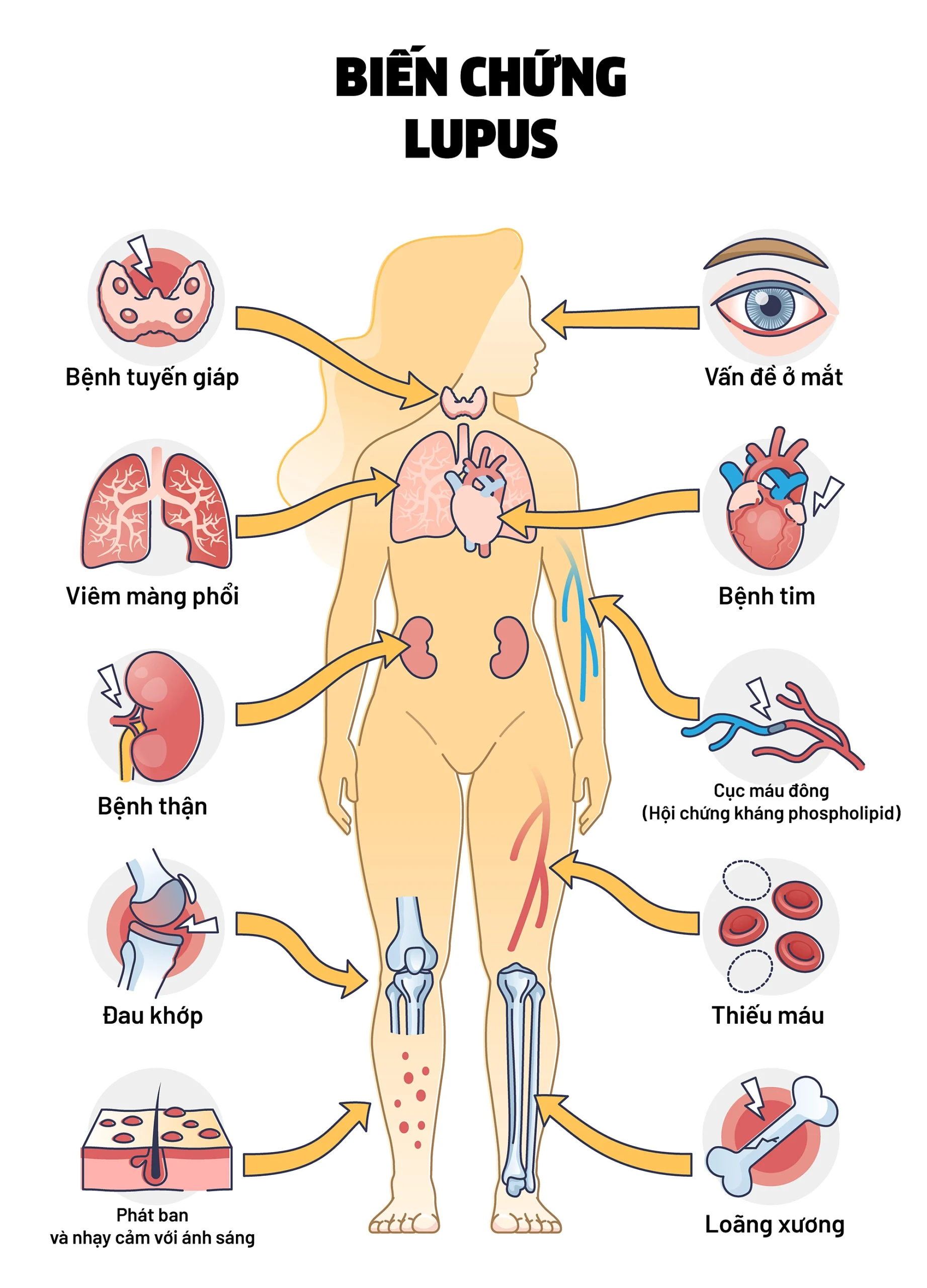 bệnh thận mạn do lupus - Image 5