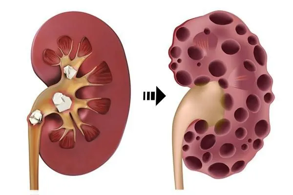 bệnh thận mạn do lupus
