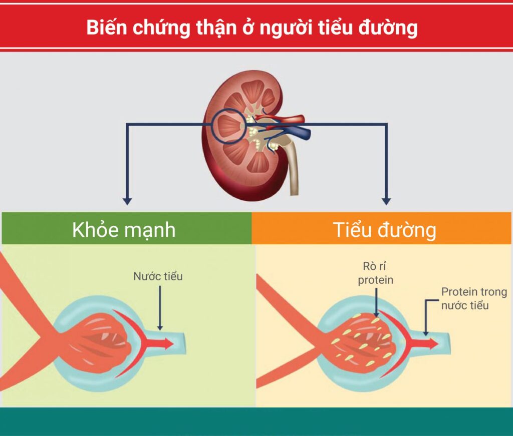 bệnh thận mạn do tiểu đường