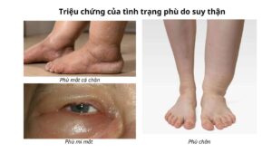 bệnh thận mạn kèm phù chân