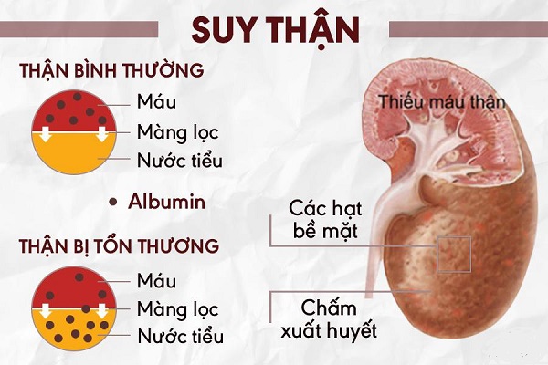 bệnh thận mạn là gì - Image 3