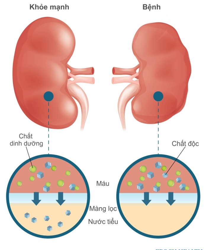 bệnh thận mạn tiến triển - Image 3