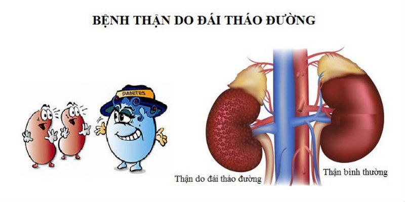 bệnh thận mạn và tiểu đường - Image 3
