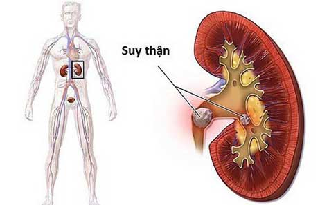 bệnh thận mạn và tiểu đường - Image 4