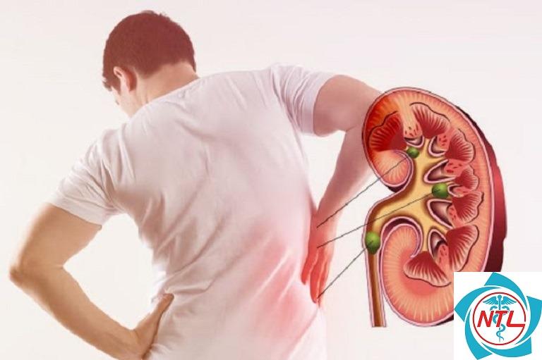 bệnh thận ở người trẻ