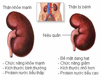 bệnh thận thường gặp - Image 3