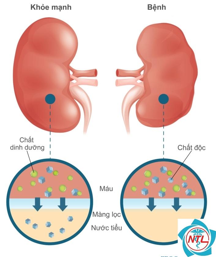bệnh thận tiến triển - Image 3