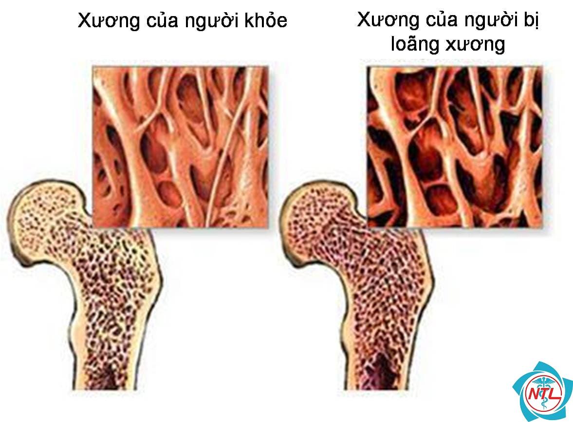 bệnh thận và loãng xương - Image 5