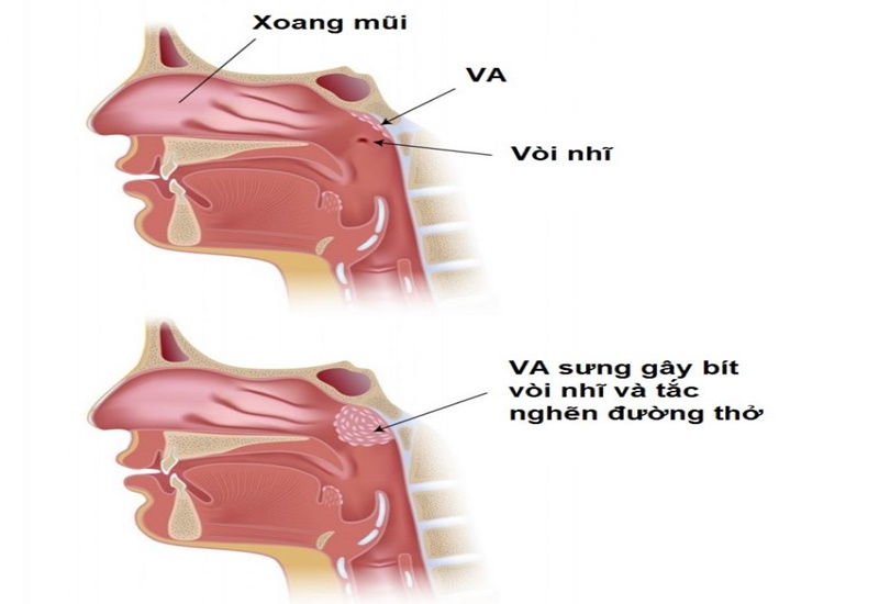 bệnh va là gì - Image 2
