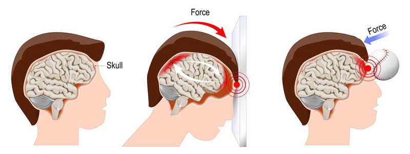 bị dập não có hồi phục được không - Image 4