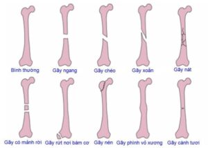 bị gãy xương có nên quan hệ