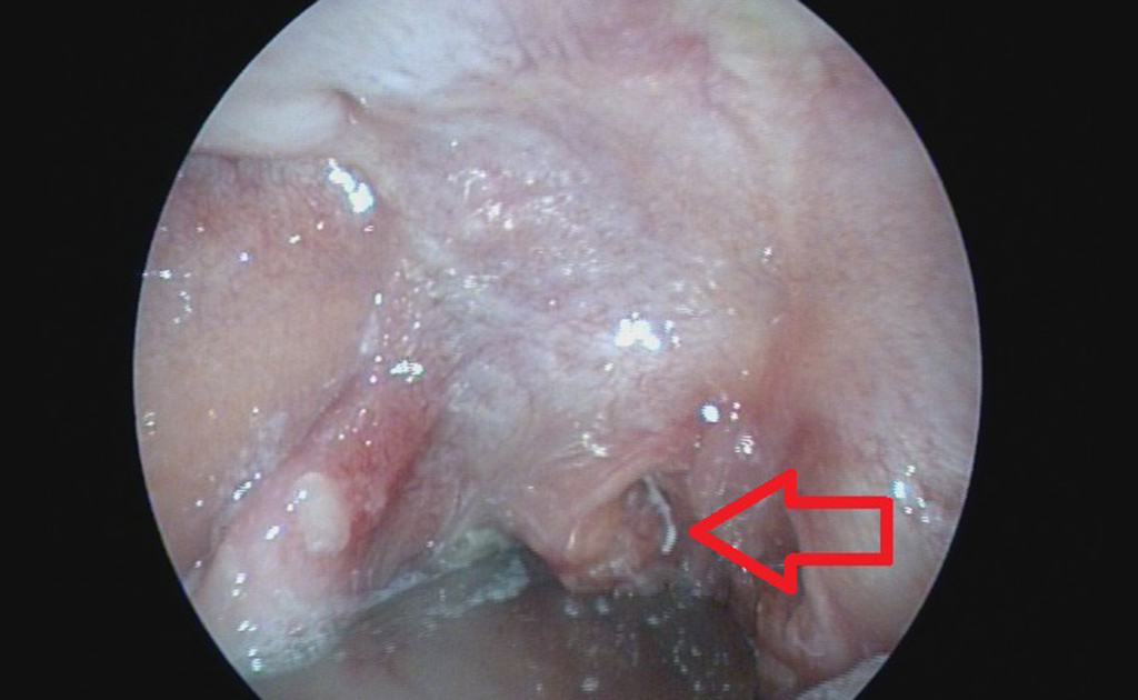 bị hóc xương cá - Image 2