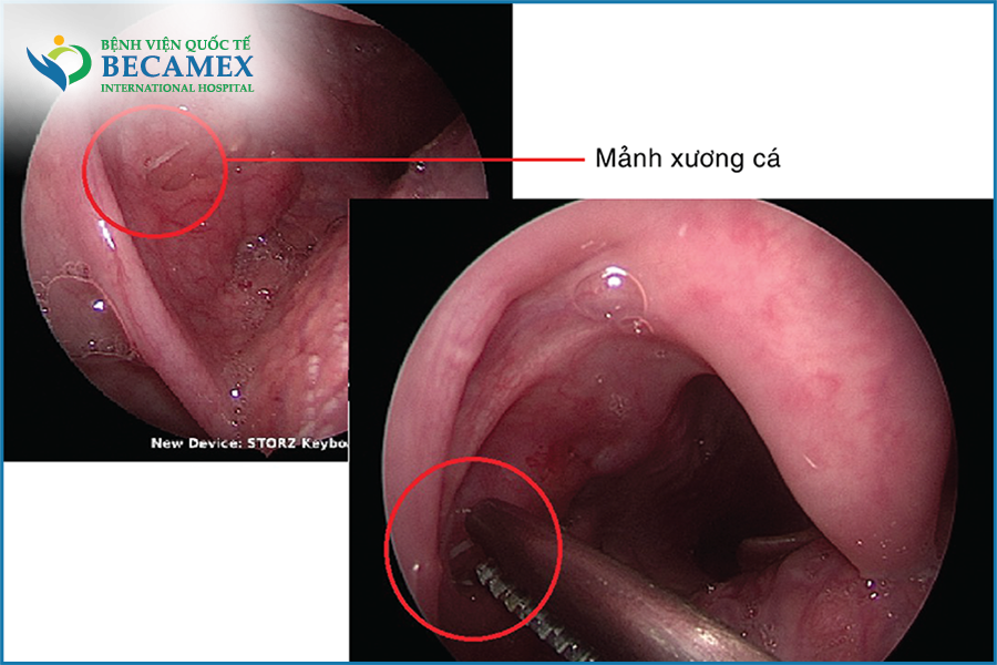bị hóc xương cá - Image 4