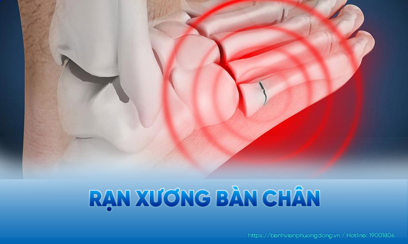 bị rạn xương bàn chân - Image 4