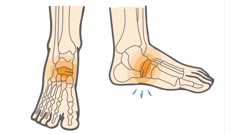 bị rạn xương bàn chân