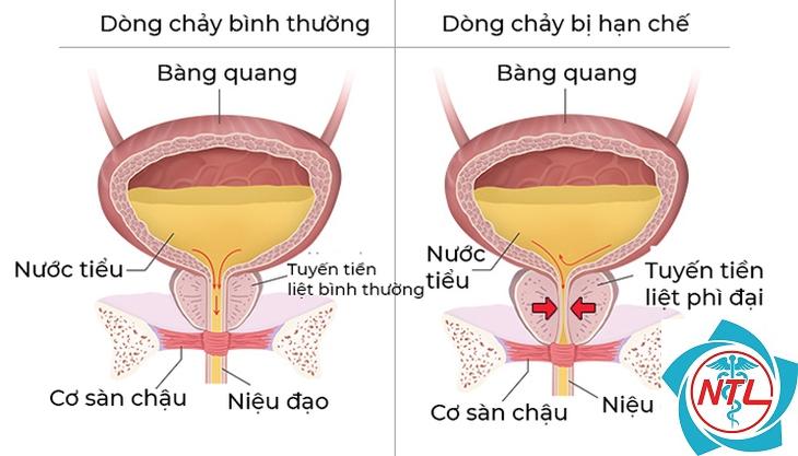 bí tiểu - Image 4