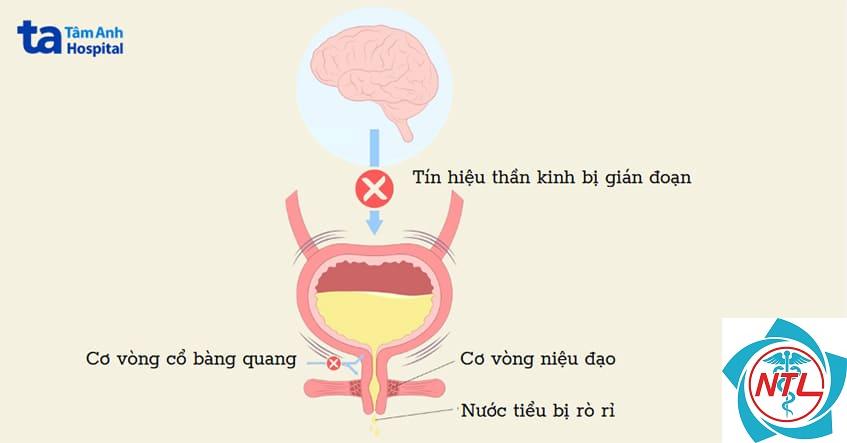 bí tiểu mạn tính - Image 2