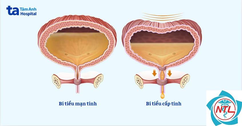 bí tiểu ở phụ nữ - Image 2