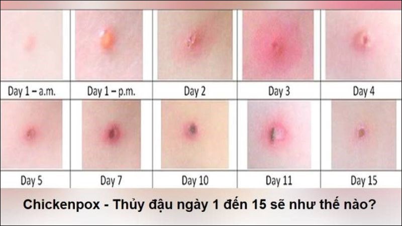 biến chứng da do thủy đậu - Image 4