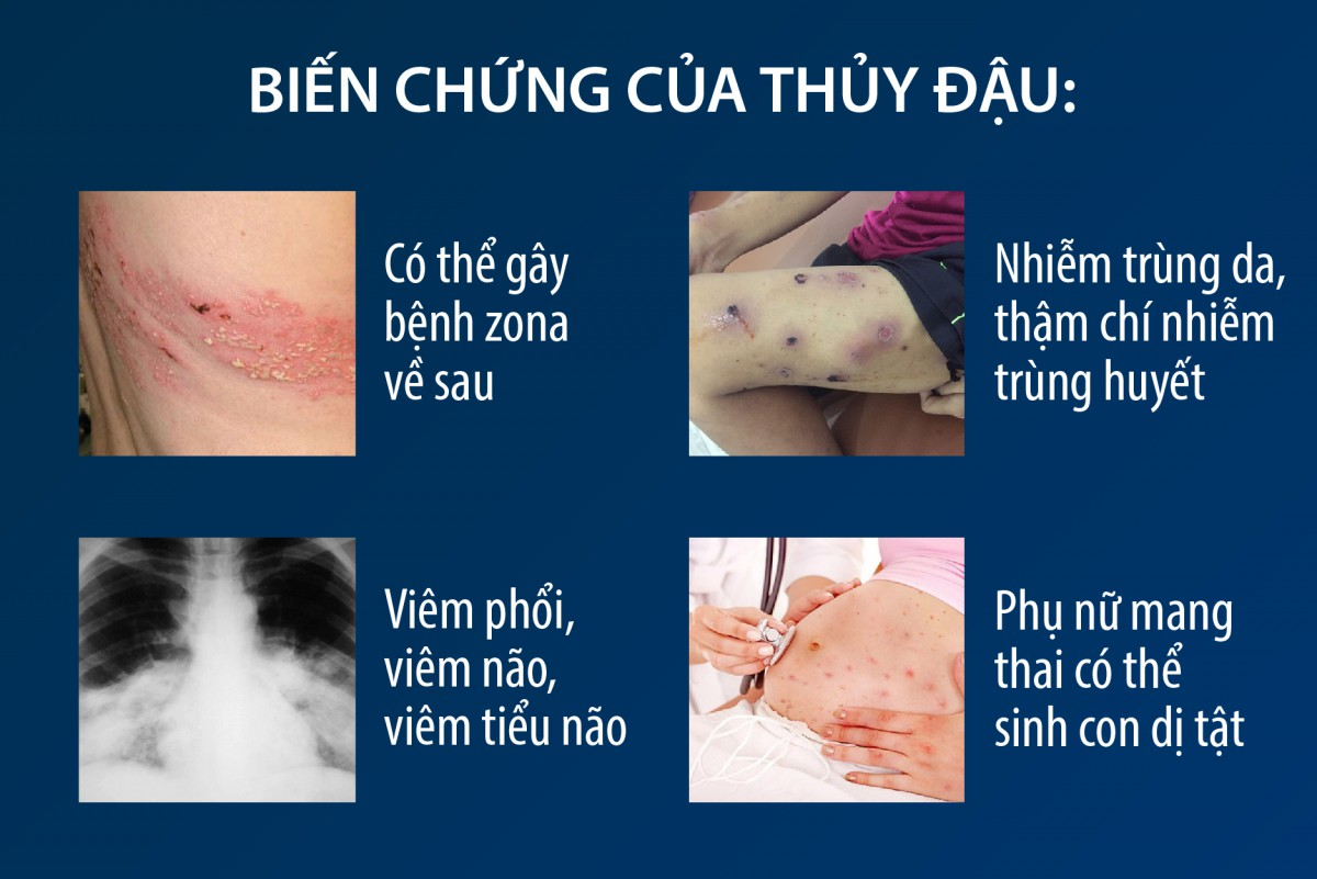 biến chứng da do thủy đậu - Image 1