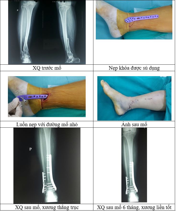 biến chứng gãy 2 xương cẳng chân - Image 3