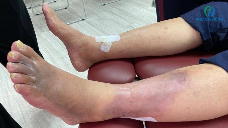 biến chứng gãy 2 xương cẳng chân