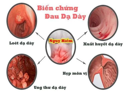 biến chứng loét dạ dày - Image 2