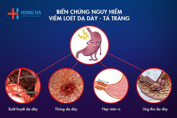 biến chứng loét dạ dày - Image 4