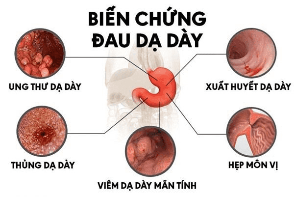 biến chứng loét dạ dày - Image 5