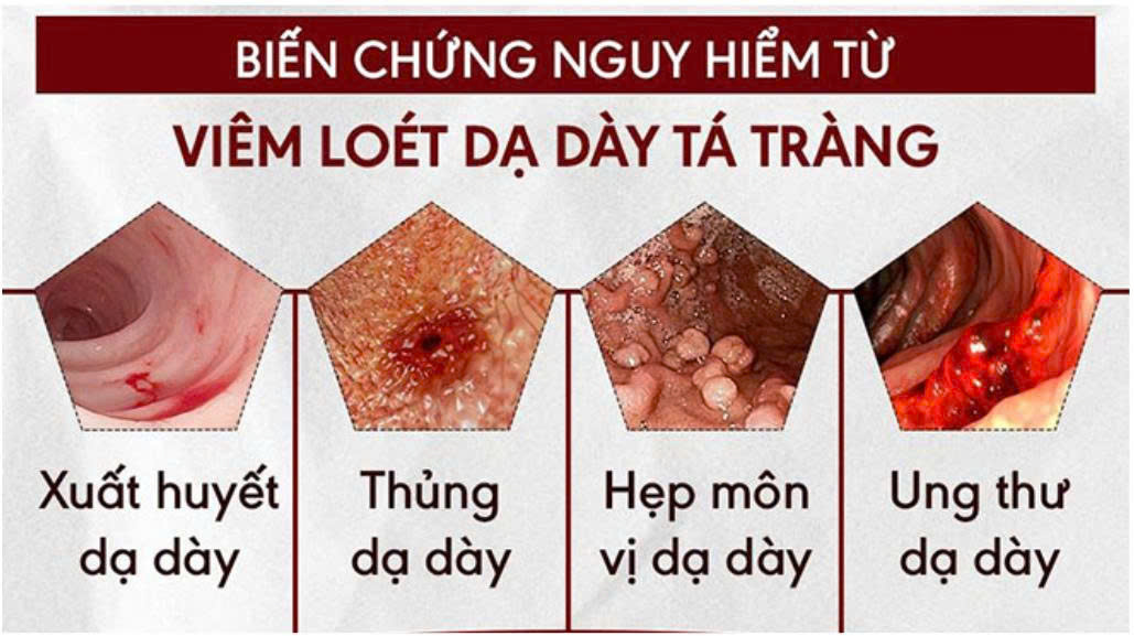 biến chứng loét dạ dày - Image 1