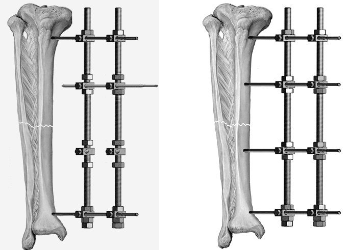 biến chứng sau mổ kết hợp xương