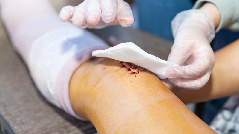 biến chứng sau phẫu thuật gãy xương - Image 2