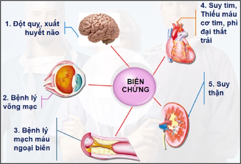 biến chứng tăng huyết áp - Image 2