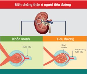 biến chứng thận do tiểu đường