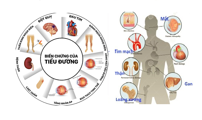 biến chứng thận do tiểu đường - Image 5