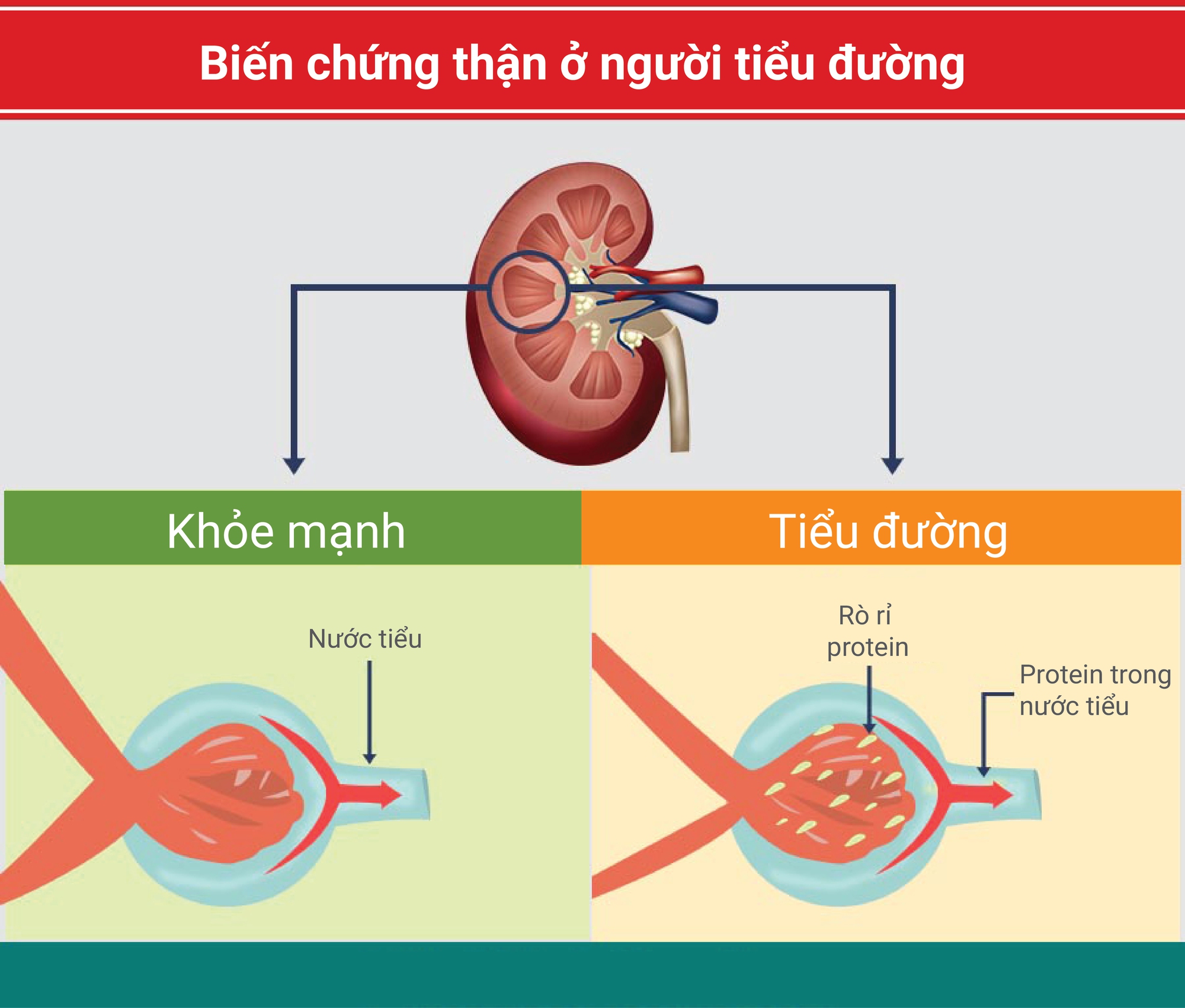 biến chứng thận do tiểu đường - Image 1