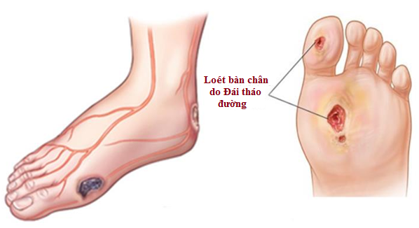 biến chứng thần kinh do tiểu đường - Image 4