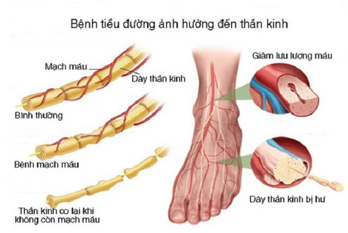 biến chứng thần kinh do tiểu đường