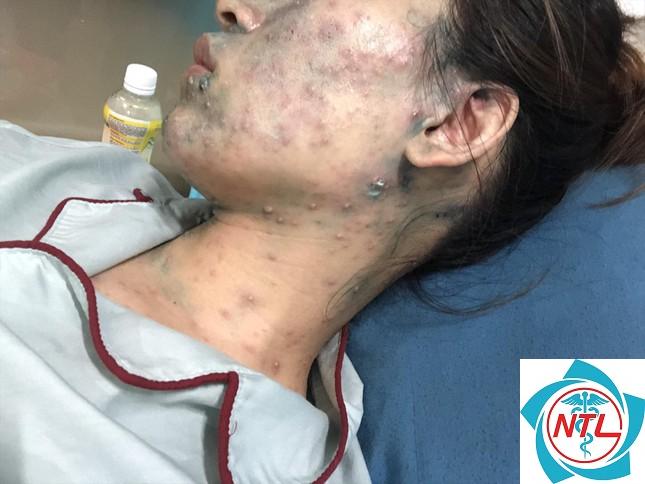 biến chứng thủy đậu ở người lớn - Image 2