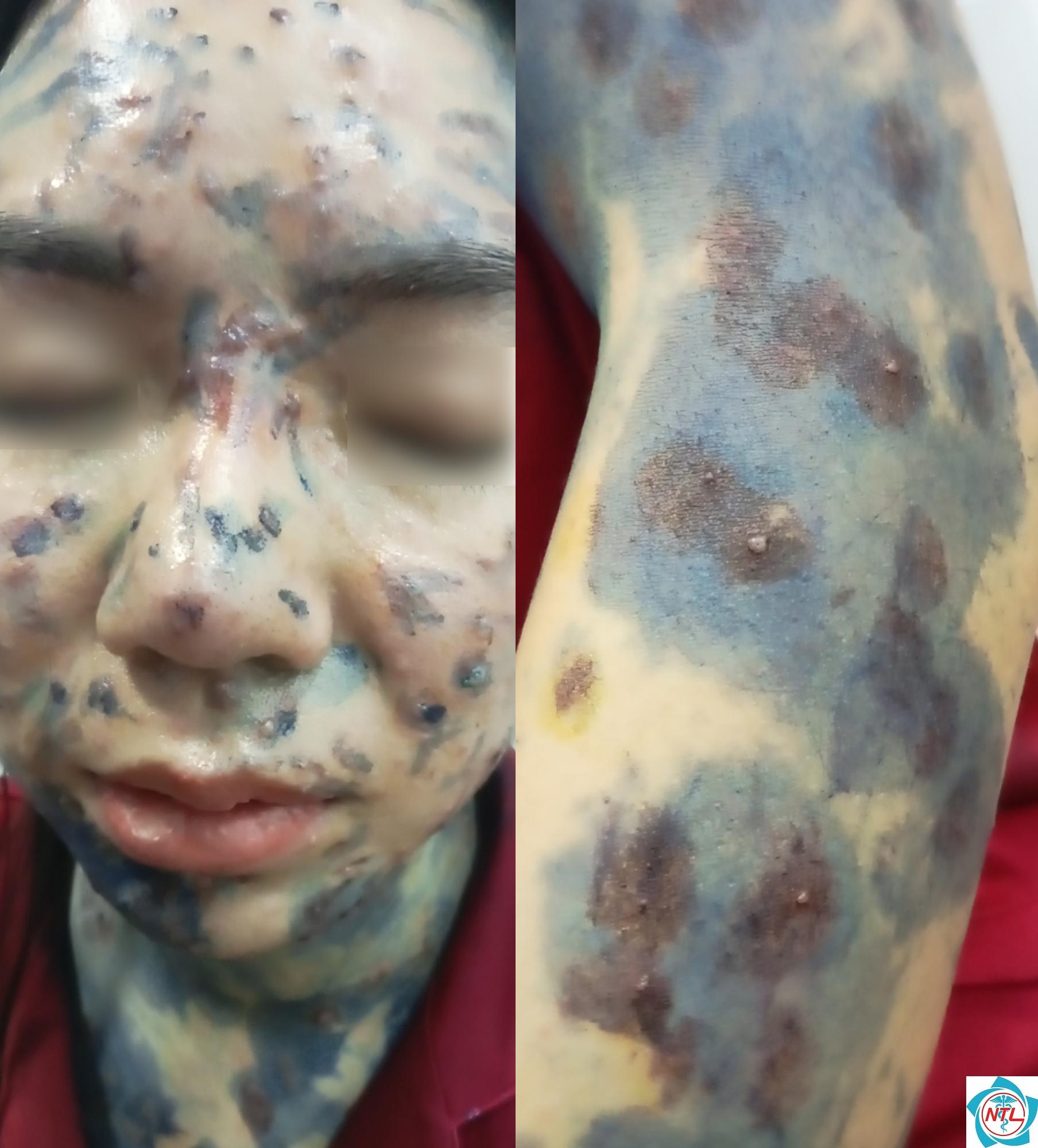 biến chứng thủy đậu ở người lớn - Image 5
