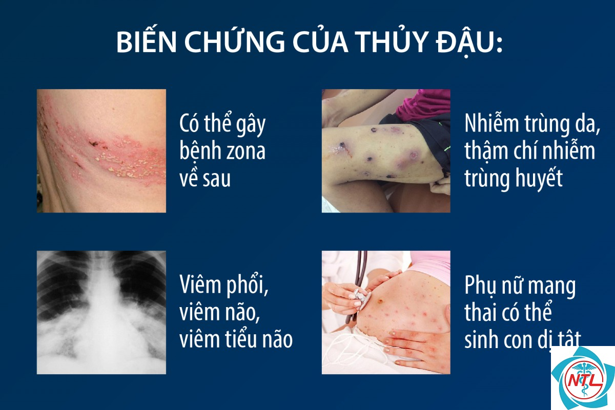 biến chứng thủy đậu ở người lớn - Image 1