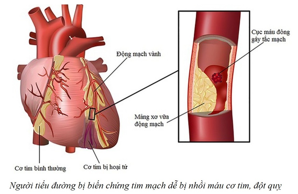 biến chứng tim mạch của tiểu đường