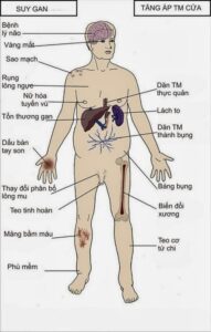 biến chứng xơ gan