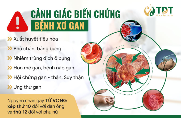 biến chứng xơ gan - Image 2