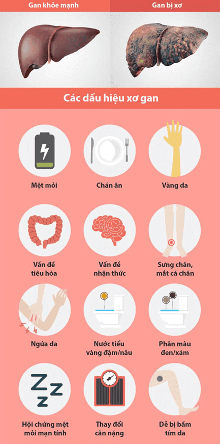 biến chứng xơ gan - Image 4