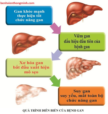 biến chứng xơ gan - Image 5