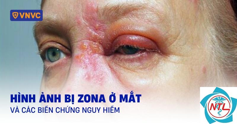 biến chứng zona mắt - Image 5