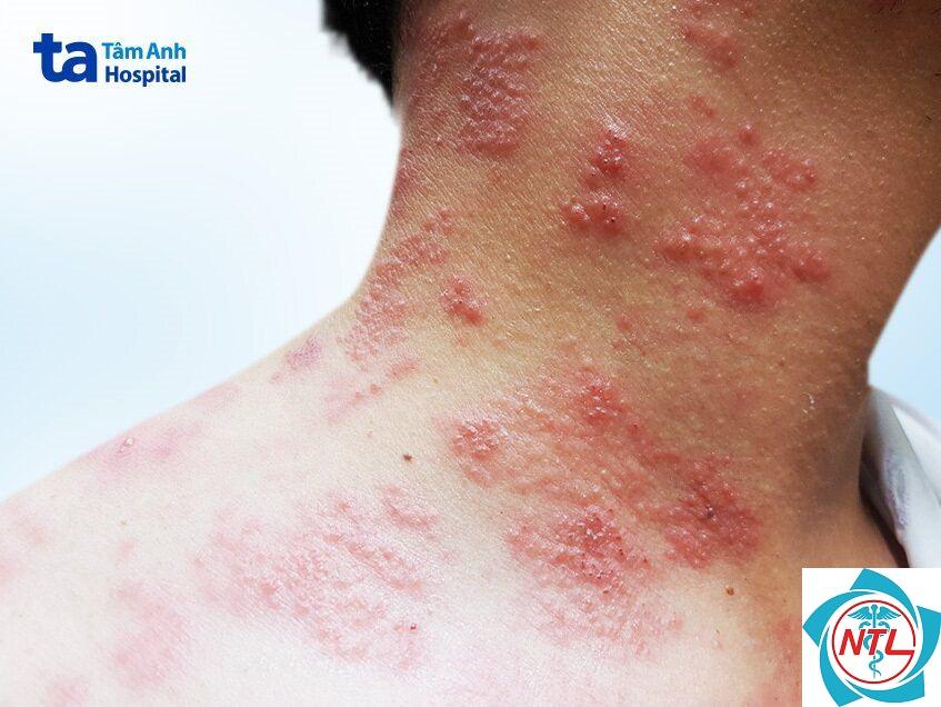 biến chứng zona thần kinh - Image 2